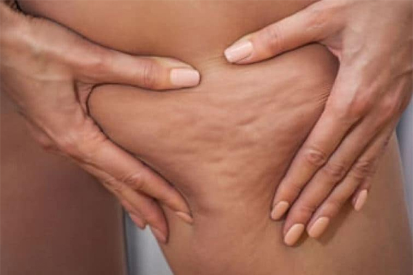 cellulite rimozione cellulite Palermo