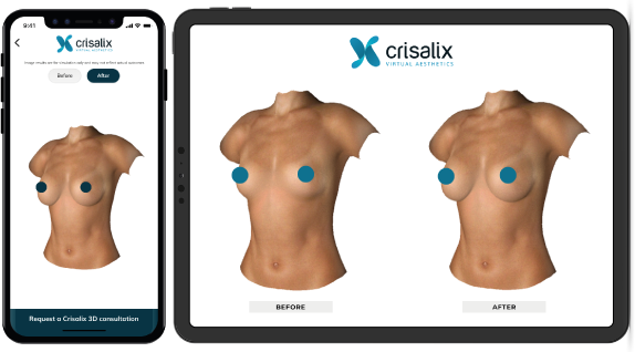 crisalix simulatore intervento seno