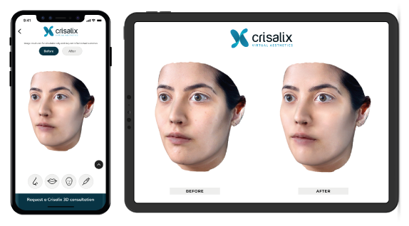 simulazione 3D crisalix rinoplastica